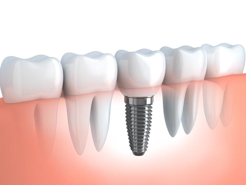 Dental Implants Easton, MD 